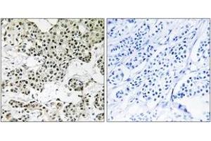 Immunohistochemistry analysis of paraffin-embedded human breast carcinoma tissue, using THOC5 Antibody. (THO Complex 5 anticorps  (AA 561-610))