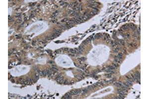 The image on the left is immunohistochemistry of paraffin-embedded Human colon cancer tissue using ABIN7129632(GNG2 Antibody) at dilution 1/60, on the right is treated with fusion protein.
