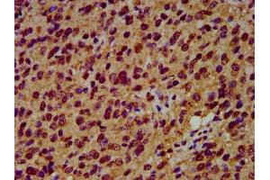IHC image of ABIN7151218 diluted at 1:600 and staining in paraffin-embedded human glioma performed on a Leica BondTM system. (SIAH2 anticorps  (AA 1-72))