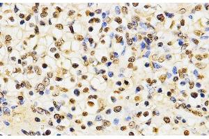 Immunohistochemistry of paraffin-embedded Human kidney cancer using MonoMethyl-Histone H3-K27 Polyclonal Antibody at dilution of 1:200 (40x lens).