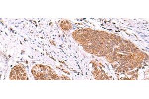 Immunohistochemistry of paraffin-embedded Human esophagus cancer tissue using ASTN2 Polyclonal Antibody at dilution of 1:80(x200) (Astrotactin 2 anticorps)