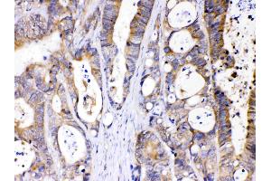 Abhd5 was detected in paraffin-embedded sections of human intestinal cancer tissues using rabbit anti- Abhd5 Antigen Affinity purified polyclonal antibody (Catalog # ) at 1 ?