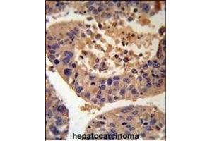 AGXT Antibody (Center) (R) IHC analysis in formalin fixed and paraffin embedded human hepatocarcinoma followed by peroxidase conjugation of the secondary antibody and DAB staining.