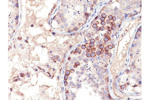Formalin-fixed, paraffin-embedded human Testicular Carcinoma stained with MAGE-1 Mouse Monoclonal Antibody (MA454).