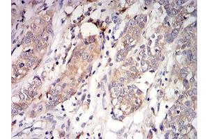 Immunohistochemical analysis of paraffin-embedded bladder cancer tissues using C1QA mouse mAb with DAB staining.