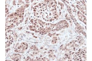 IHC-P Image Immunohistochemical analysis of paraffin-embedded A549 xenograft, using RNF13, antibody at 1:500 dilution.