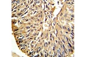 DHFR antibody IHC analysis in formalin fixed and paraffin embedded human lung carcinoma.