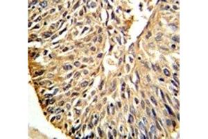 DHFR antibody IHC analysis in formalin fixed and paraffin embedded human lung carcinoma. (Dihydrofolate Reductase anticorps  (AA 135-164))
