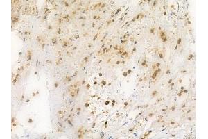 ABIN6261409 and ABIN6269309 at 1/100 staining human breast carcinoma by IHC-P. (E2F1 anticorps  (C-Term))