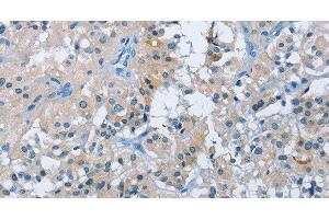 Immunohistochemistry of paraffin-embedded Human thyroid cancer tissue using BTN2A2 Polyclonal Antibody at dilution 1:50