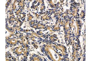 ABIN7096696 and ABIN7100761 at 1/100 staining human colorectal cancer by IHC-P.