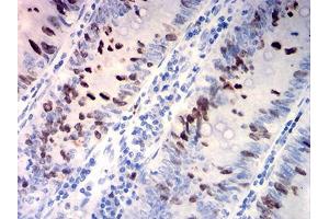 Immunohistochemical analysis of paraffin-embedded rectum cancer tissues using TOP2A mouse mAb with DAB staining. (Topoisomerase II alpha anticorps  (AA 1100-1530))