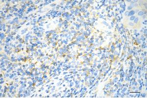 Immunohistochemistry was performed on paraffin-embedded human esophageal carcinoma using diaphanous related formin 1 antibody (ABIN7798330), 1:200). (Recombinant DIAPH1 anticorps)