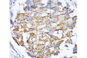 Immunohistochemistry of paraffin-embedded Human breast cancer using NDE1 Polyclonal Antibody at dilution of 1:100 (40x lens). (NDE1 anticorps)