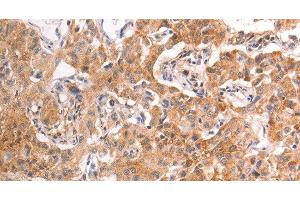 Immunohistochemistry of paraffin-embedded Human liver cancer tissue using TRPV4 Polyclonal Antibody at dilution 1:40