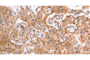 Immunohistochemistry of paraffin-embedded Human liver cancer tissue using TRPV4 Polyclonal Antibody at dilution 1:40 (TRPV4 anticorps)