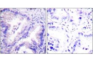 Immunohistochemistry analysis of paraffin-embedded human lung carcinoma tissue, using PP2A-alpha (Ab-307) Antibody. (PPP2CA anticorps  (AA 260-309))
