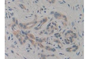 Detection of PIK3C3 in Human Pancreatic cancer Tissue using Polyclonal Antibody to Phosphoinositide-3-Kinase Class 3 (PIK3C3)