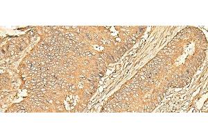 Immunohistochemistry of paraffin-embedded Human colorectal cancer tissue using RPS28 Polyclonal Antibody at dilution of 1:30(x200) (RPS28 anticorps)