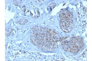 Formalin-fixed, paraffin-embedded human breast carcinoma stained with MDM2 Mouse Monoclonal Antibody (SMP14).