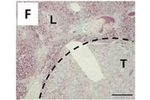 Immunostaining for HBsAg (ABIN285516) demonstrates the loss of transgene expression in tumors. (HBSAg anticorps)