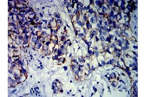 Immunohistochemical analysis of paraffin-embedded bladder cancer tissues using KRT13 mouse mAb with DAB staining.