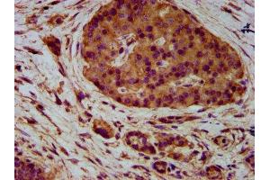 IHC image of ABIN7161114 diluted at 1:400 and staining in paraffin-embedded human pancreatic cancer performed on a Leica BondTM system.