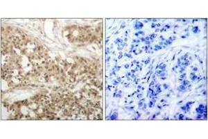 Immunohistochemistry analysis of paraffin-embedded human breast carcinoma, using PKC thet (Phospho-Ser676) Antibody. (PKC theta anticorps  (pSer676))