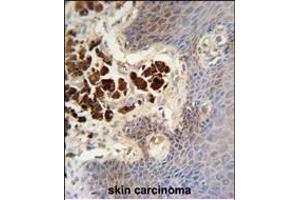 COL19A1 antibody (N-term) (ABIN654432 and ABIN2844168) immunohistochemistry analysis in formalin fixed and paraffin embedded human skin carcinoma followed by peroxidase conjugation of the secondary antibody and DAB staining. (COL19A1 anticorps  (N-Term))