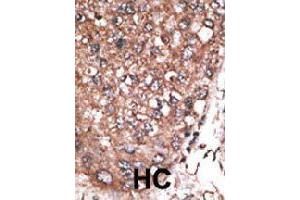 Formalin-fixed and paraffin-embedded human hepatocellular carcinoma tissue reacted with HAND2 polyclonal antibody  , which was peroxidase-conjugated to the secondary antibody, followed by AEC staining. (HAND2 anticorps  (C-Term))