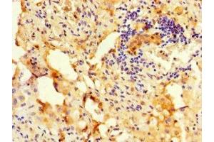 Immunohistochemistry of paraffin-embedded human lung cancer using ABIN7168333 at dilution of 1:100 (RBM12 anticorps  (AA 1-200))