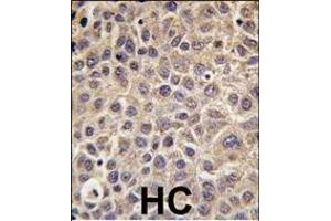 Formalin-fixed and paraffin-embedded human hepatocarcinoma tissue reacted with MTMR9 antibody , which was peroxidase-conjugated to the secondary antibody, followed by DAB staining. (MTMR9 anticorps  (C-Term))