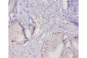 Immunohistochemistry of paraffin-embedded human prostate tissue using ABIN7160281 at dilution of 1:20 (MUC16 anticorps  (AA 14067-14328))