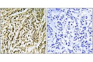 Immunohistochemistry analysis of paraffin-embedded human breast carcinoma tissue, using FEN1 Antibody. (FEN1 anticorps  (AA 86-135))