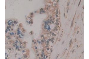 Detection of RSPO3 in Human Bile duct cancer Tissue using Polyclonal Antibody to R-Spondin 3 (RSPO3)