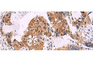 Immunohistochemistry of paraffin-embedded Human cervical cancer tissue using FKBP4 Polyclonal Antibody at dilution of 1:65(x200)