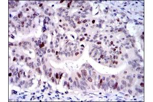 Immunohistochemical analysis of paraffin-embedded rectum cancer tissues using KID mouse mAb with DAB staining.