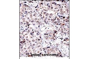 SIRT6 Antibody (C-term) ((ABIN657945 and ABIN2846889))immunohistochemistry analysis in formalin fixed and paraffin embedded human breast carcinoma followed by peroxidase conjugation of the secondary antibody and DAB staining. (SIRT6 anticorps  (C-Term))