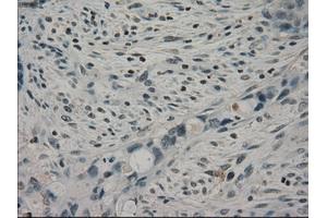 Immunohistochemical staining of paraffin-embedded Adenocarcinoma of colon tissue using anti-CRYABmouse monoclonal antibody. (CRYAB anticorps)