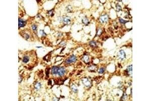 IHC analysis of FFPE human hepatocarcinoma stained with the Dnmt3a antibody (DNMT3A anticorps  (AA 457-486))