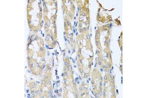 Immunohistochemistry of paraffin-embedded human gastric cancer using CCL3 antibody at dilution of 1:100 (40x lens).