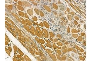ABIN6260411 and ABIN6269331 at 1/100 staining human tongue carcinoma by IHC-P. (Caldesmon anticorps  (C-Term))