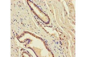 Immunohistochemistry of paraffin-embedded human prostate cancer using ABIN7144980 at dilution of 1:100 (DDX19A anticorps  (AA 1-478))