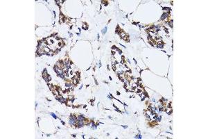 Immunohistochemistry of paraffin-embedded human breast cancer using TP53 antibody.