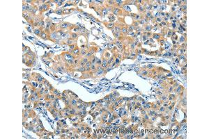 Immunohistochemistry of Human lung cancer using SERPINA3 Polyclonal Antibody at dilution of 1:55 (SERPINA3 anticorps)