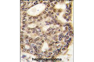 Formalin-fixed and paraffin-embedded human hepatocellular carcinoma reacted with HDGF polyclonal antibody  , which was peroxidase-conjugated to the secondary antibody, followed by DAB staining . (HDGF anticorps  (C-Term))