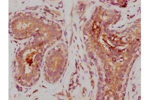 IHC image of ABIN7127625 diluted at 1:235 and staining in paraffin-embedded human breast cancer performed on a Leica BondTM system.