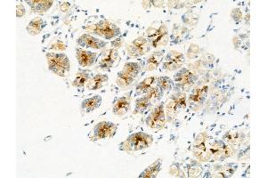 Phospho-MAFB (Ser304) Antibody at 1/100 staining Human gastric cancer and adjacent normal tissues by IHC-P. (MAFB anticorps  (pSer304))