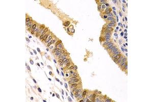 Immunohistochemistry of paraffin-embedded human uterine cancer using CXCR3 Antibody. (CXCR3 anticorps)