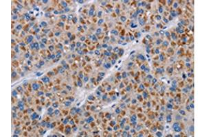 The image on the left is immunohistochemistry of paraffin-embedded Human liver cancer tissue using ABIN7190333(COX18 Antibody) at dilution 1/20, on the right is treated with synthetic peptide. (COX18 anticorps)